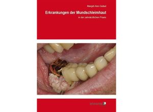 9783865416117 - Erkrankungen der Mundschleimhaut - Margrit-Ann Geibel Kartoniert (TB)